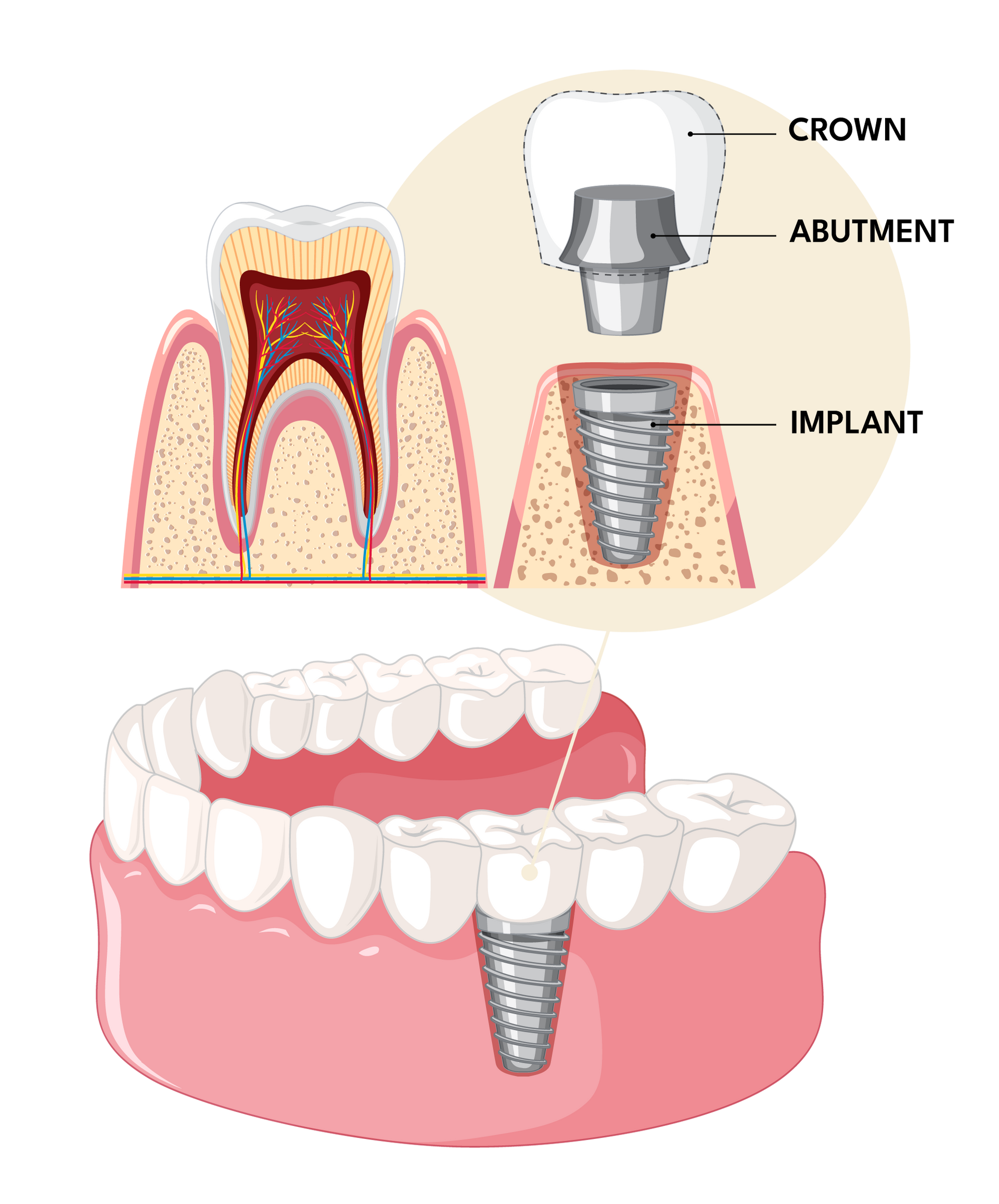 IMPLANT DENTISTRY The Smile Suite in CO
