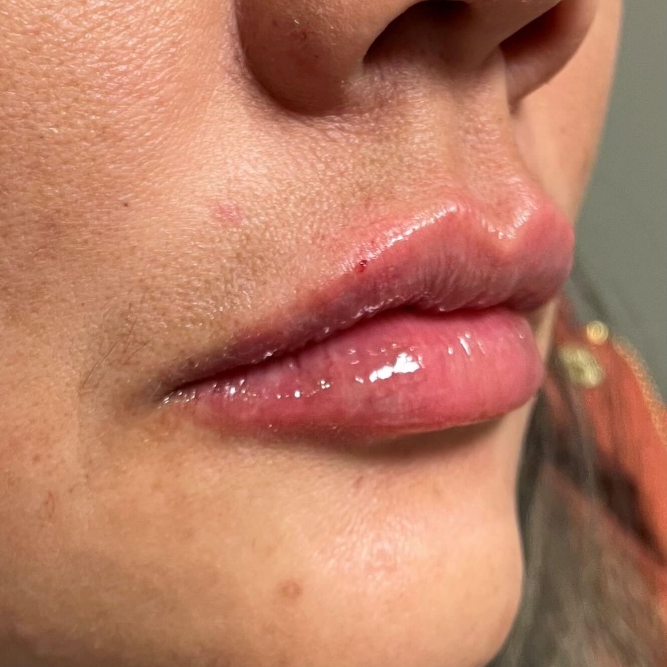 Close-up of a person's lips. The lips are glossy, plumped, and have a slight pink tint.