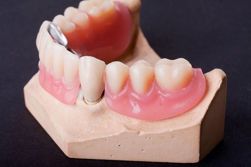 Missing Teeth — Kansas City, MO — Koehn Dentistry & Aesthetics Missing Teeth — Kansas City, MO — Koehn Dentistry & Aesthetics