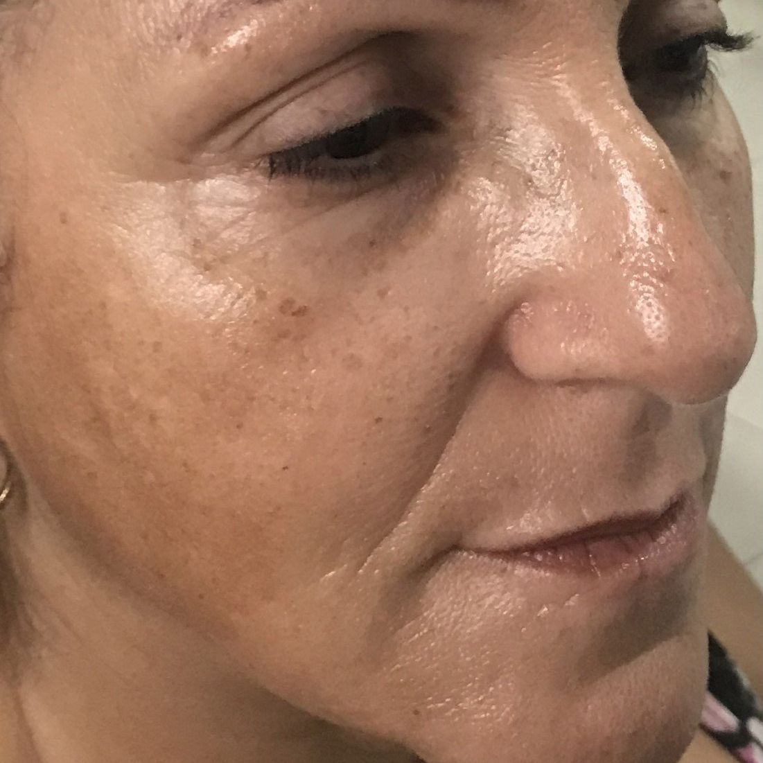 Close-up of a woman's face with dark spots, wrinkles, and oily skin, lit from above.