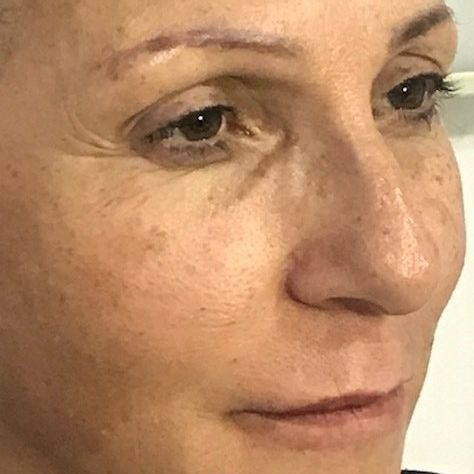 Close-up of a person's face; visible wrinkles and freckles, soft lighting.
