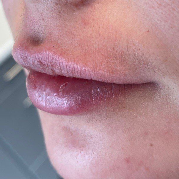Close-up of a person's lips. The lower lip is slightly cracked and the upper lip is dry. Skin is fair.
