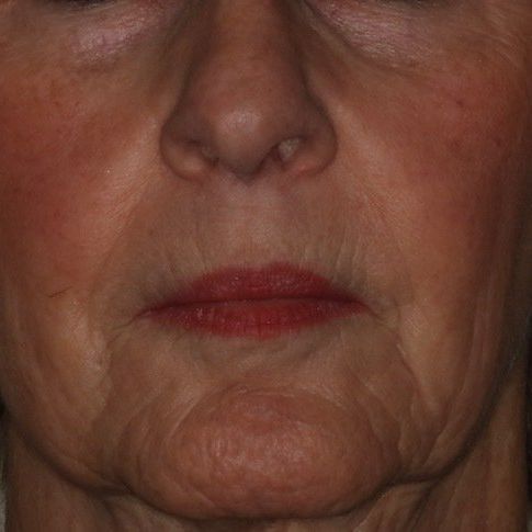 Close-up of a person's face showing wrinkles and reddish lipstick.