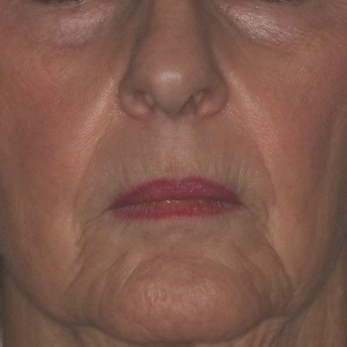 Close-up of a person's face; visible nose, red lipstick, and wrinkles around the mouth and chin.