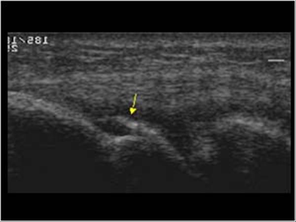 Echo van de elleboog avulsie van radial collateral ligament