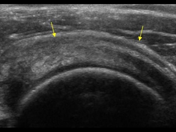 Slijmbeurs ontsteking acute bursitis schouder pijn chronisch