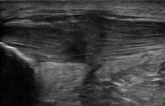 Echo van de knie ter hoogte van de kniepees patellar tendon