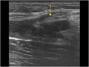 Echo van een heup spier hamstring