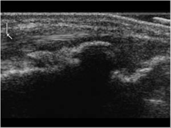 Echo van de knie Osgood Schlatter