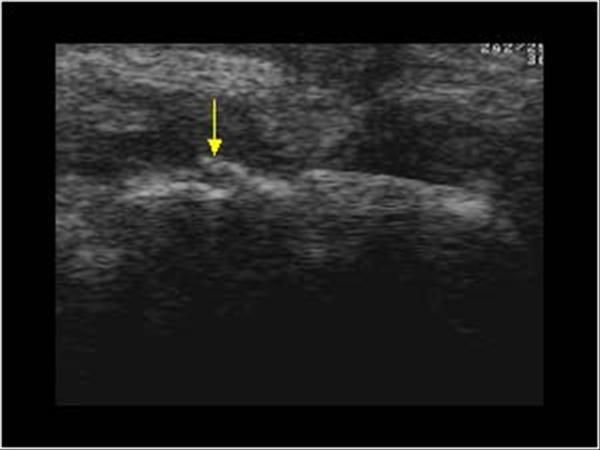 Echo van een pols scaphoid breuk 
