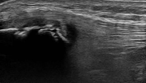 Echo van de knie ter hoogte van de knie pees Sinding Larsen Johansson