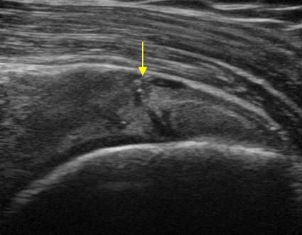 Echo van de schouder met een scheur in de supraspinatus