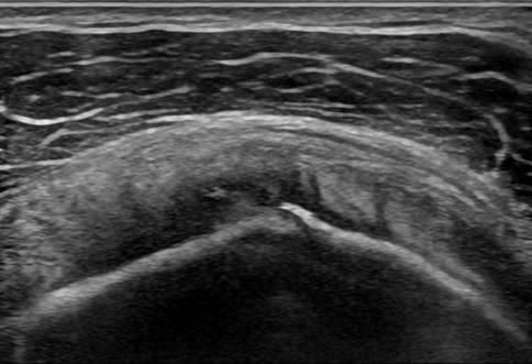 Echo van de schouder met een supraspinatus tendinosis