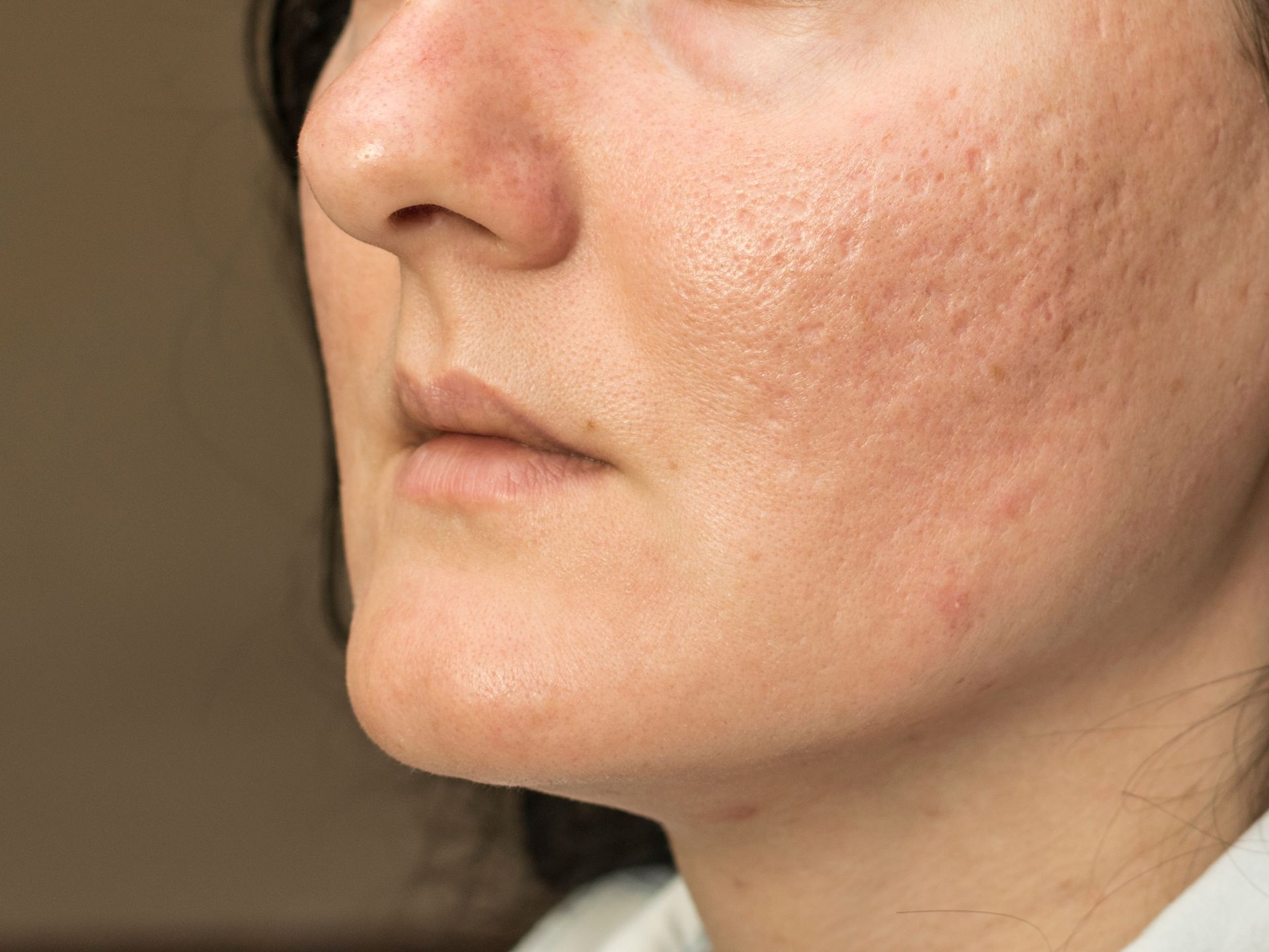 Woman's face with acne scars on cheek, showing pitted skin texture.