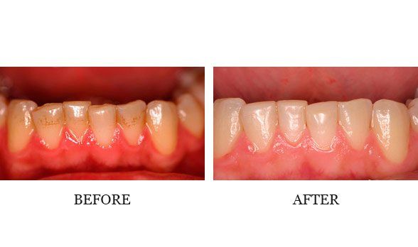 Whitening and bonding Dr. Steve