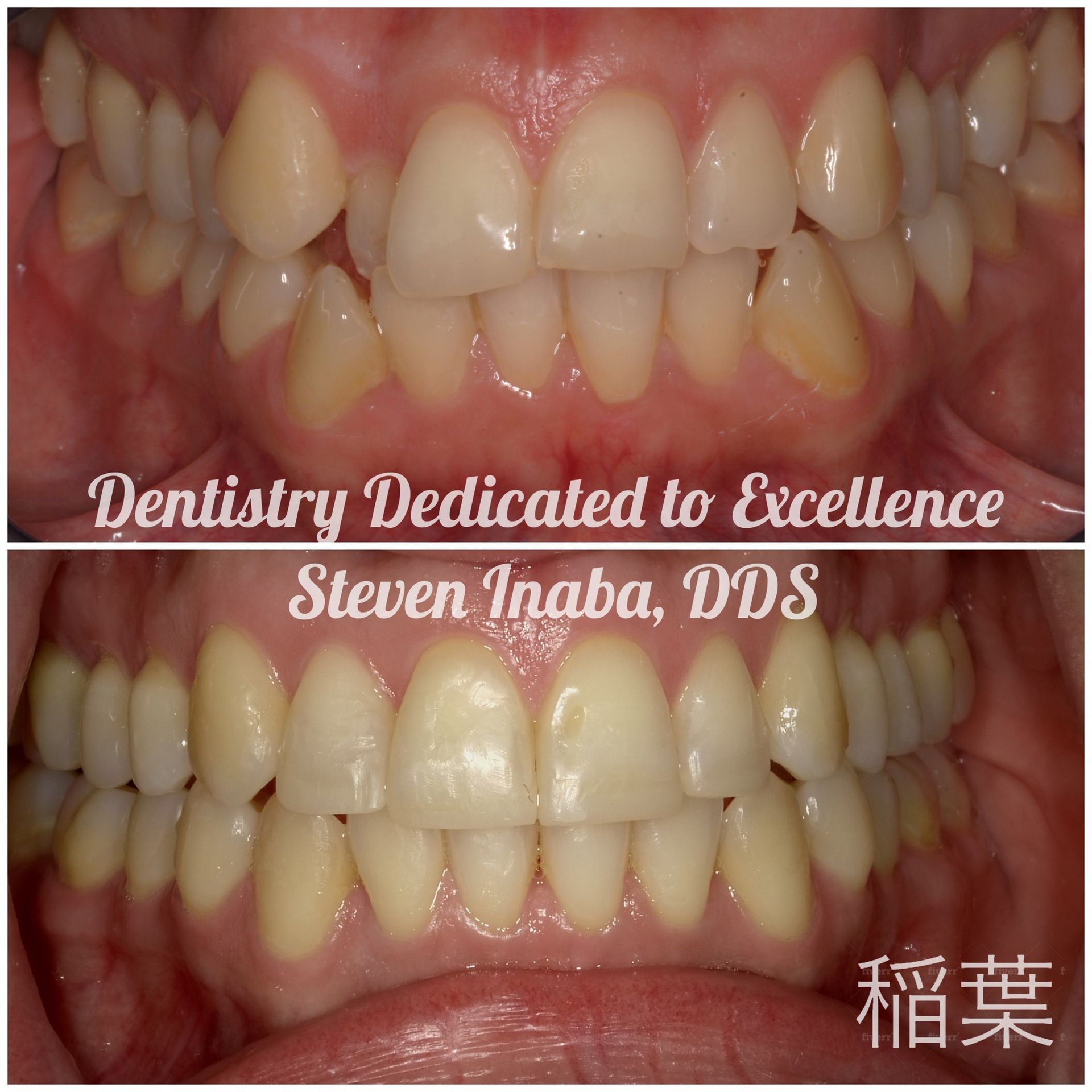 A before and after photo of a person 's teeth taken by steven inaba dds