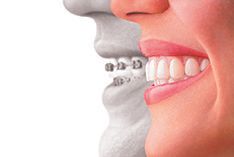 A close up of a woman 's mouth with braces and without braces.