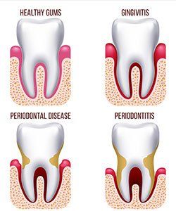 A diagram of healthy gums , gingivitis , periodontal disease , and periodontitis.
