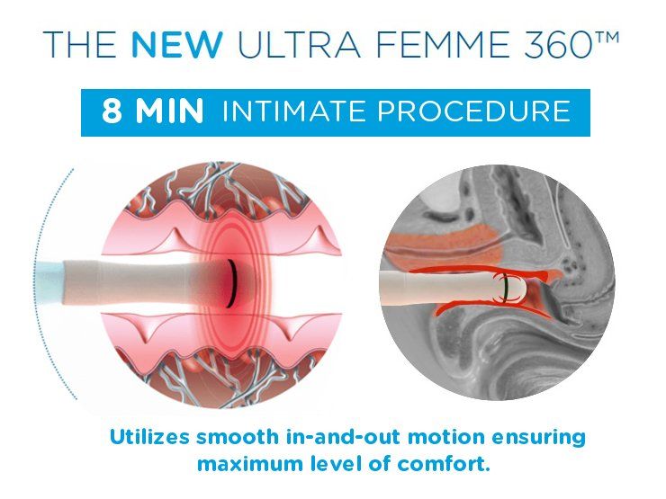 Exilis Ultra Femme 360 Vaginal Rejuvination - Wall, NJ - Mirelle Anti Aging Exilis Ultra Femme 360 Vaginal Rejuvination - Wall, NJ - Mirelle Anti Aging