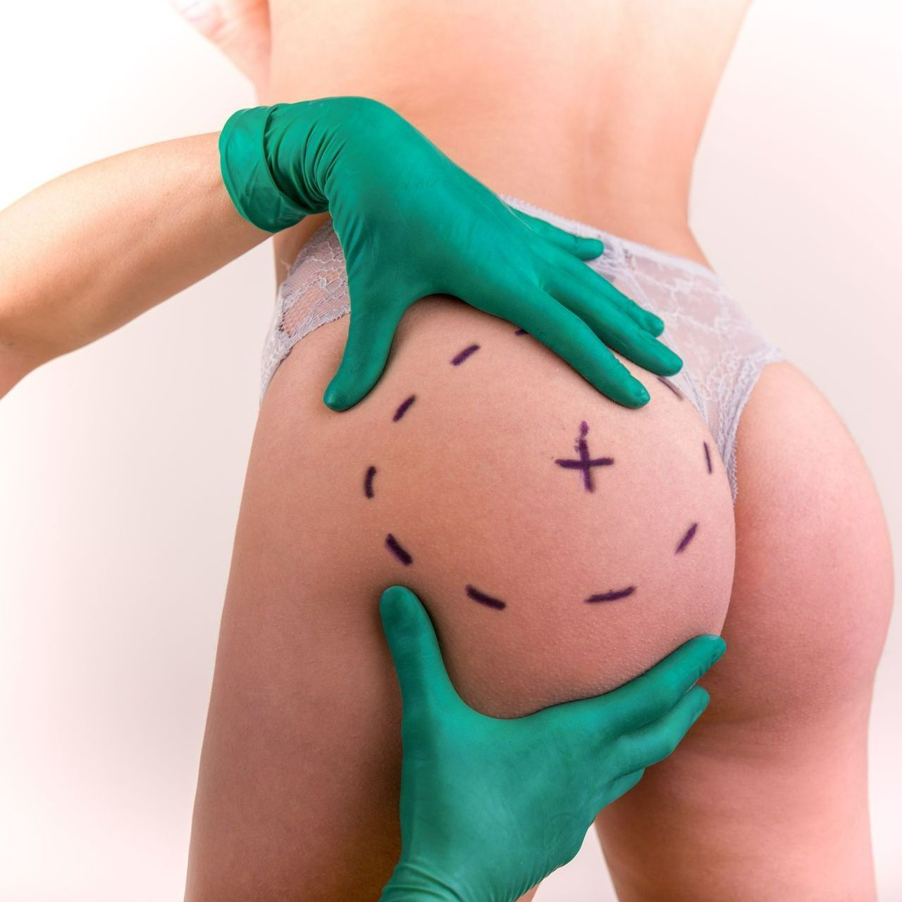 Non-Surgical Brazilian Buttock Lift Results at Mirelle Institute for Anti-Aging