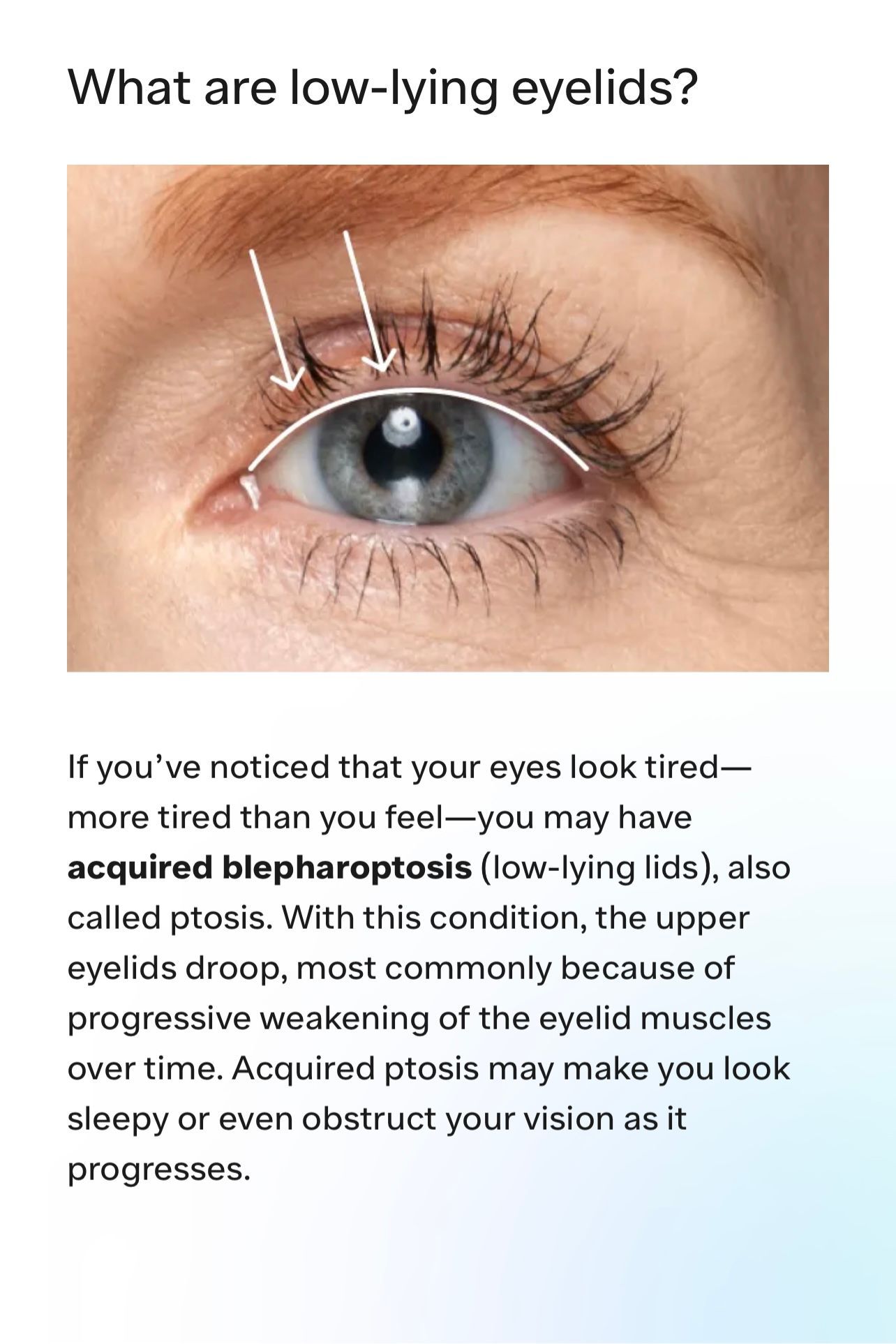 UPNEEQ Eyelift Without Surgery — Wall, NJ —Mirelle Anti Aging