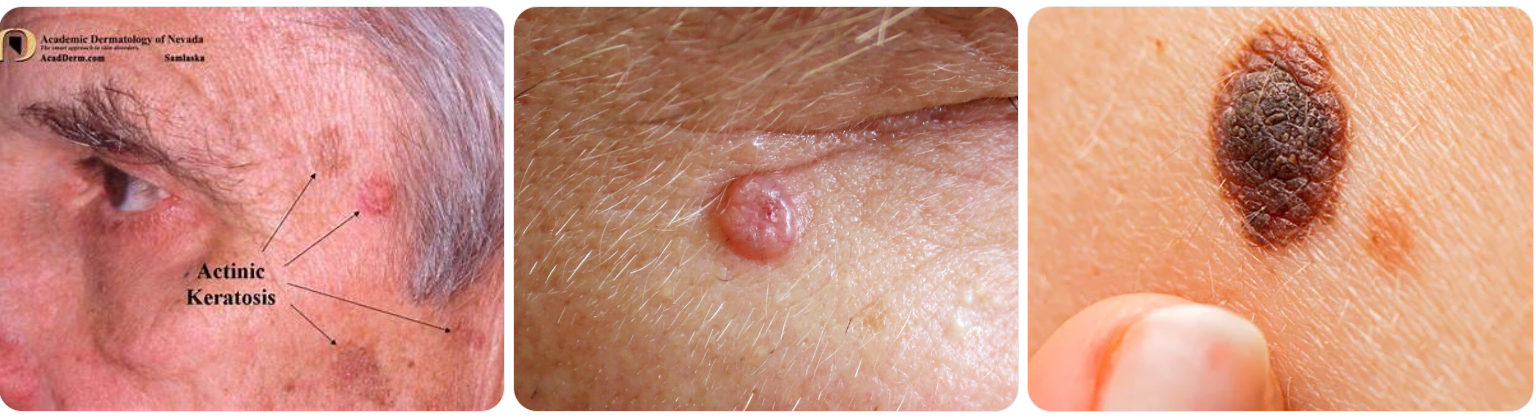 Pre-cancerous leasion on the face