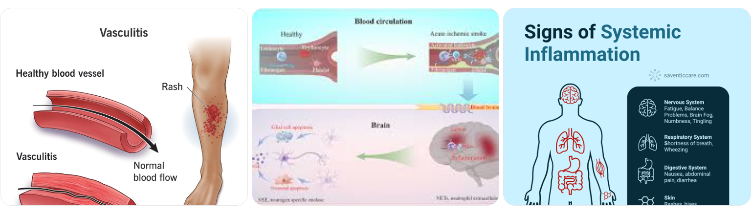 Internal inflammation affecting the entire body