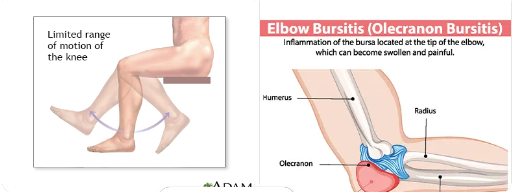 Joint pain caused by inflammation