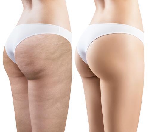 Exilis Ultra 360 Cellulite Treatment - Wall, NJ - Mirelle Anti Aging A before and after image of body sculpting near Spring Lake, NJ
