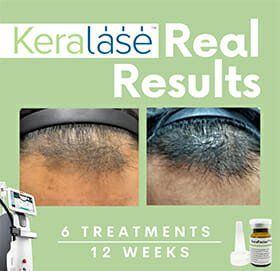 Hair Loss Treatments — Wall, NJ —Mirelle Anti Aging