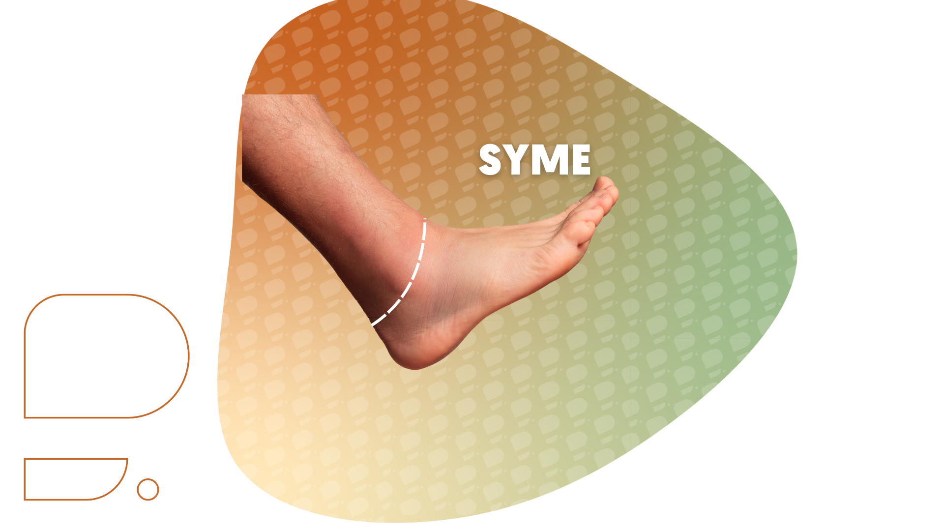 amputação Syme