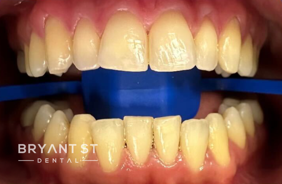 A close up of a person 's teeth with a blue rubber band around them.