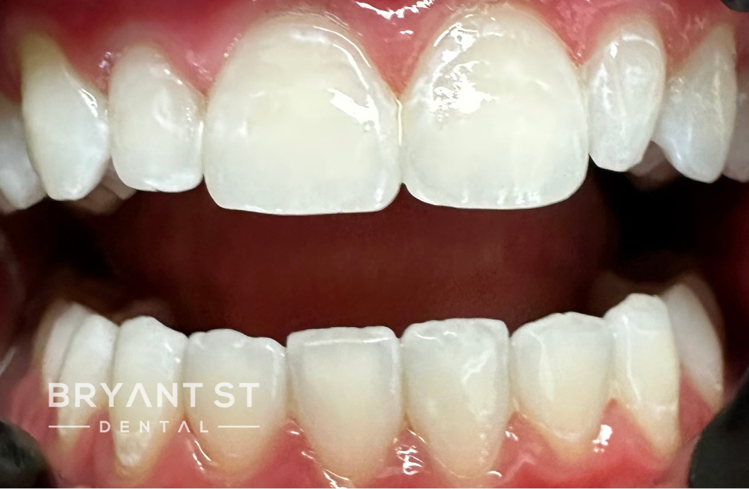 A close up of a person 's teeth with white teeth