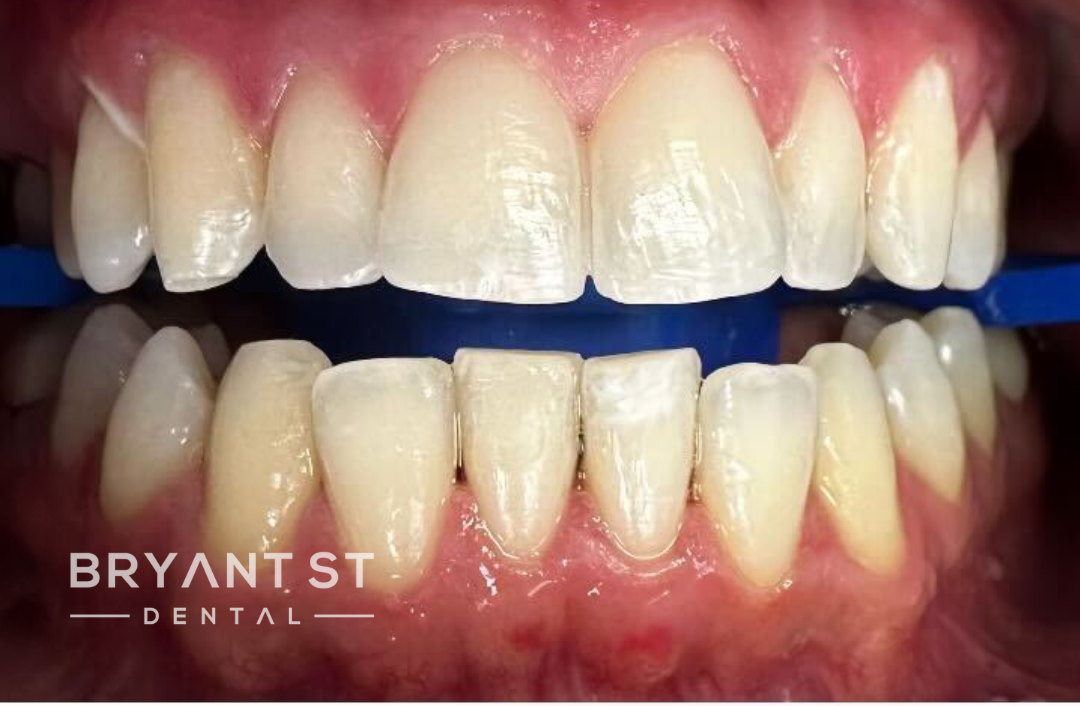 A close up of a person 's teeth with a blue band around them.
