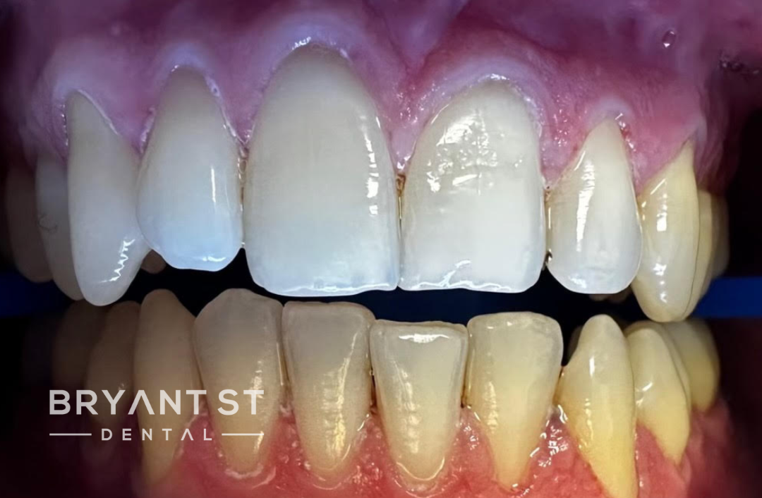 A close up of a person 's teeth with a blue light shining on them.