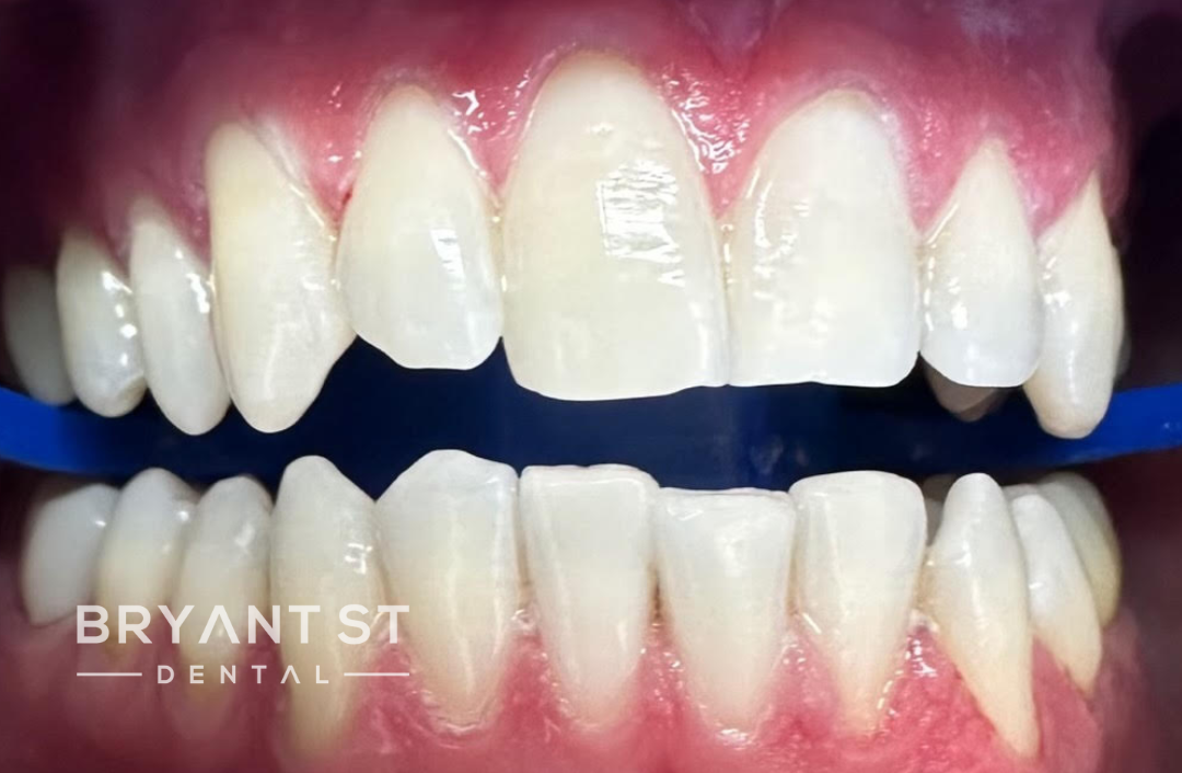 A close up of a person 's teeth with a blue rubber band around them.