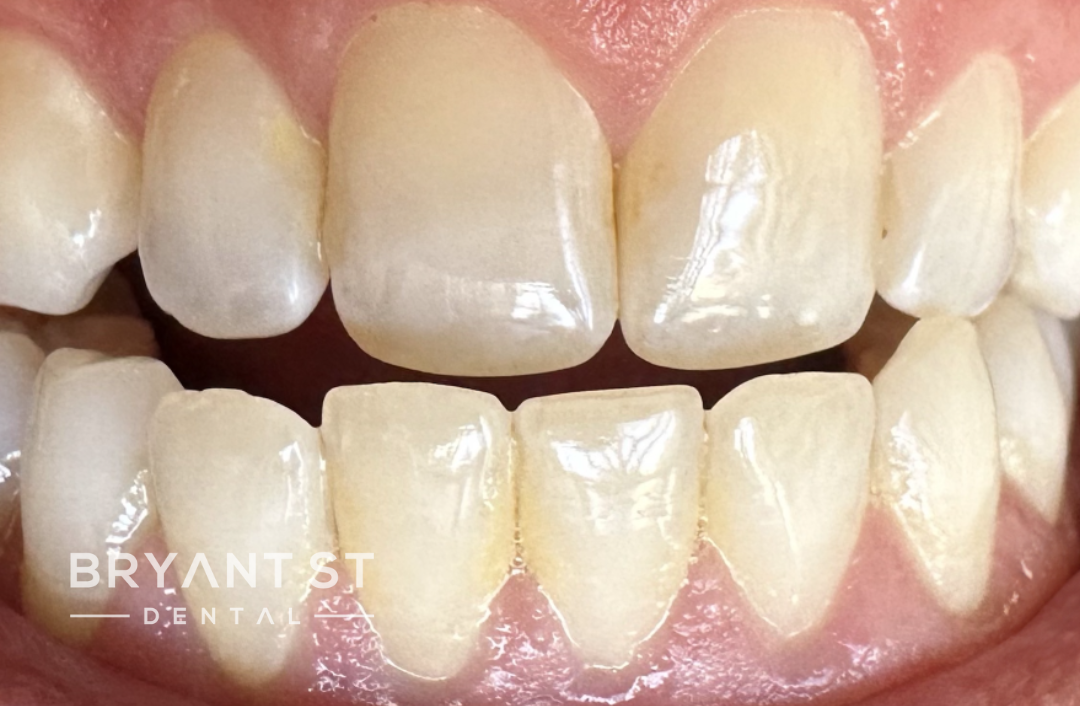 A close up of a person 's teeth with white teeth.