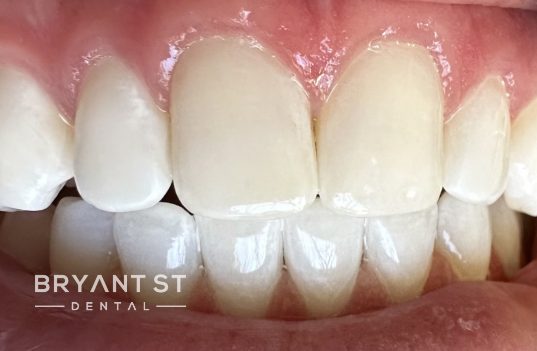 A close up of a person 's teeth with white teeth.