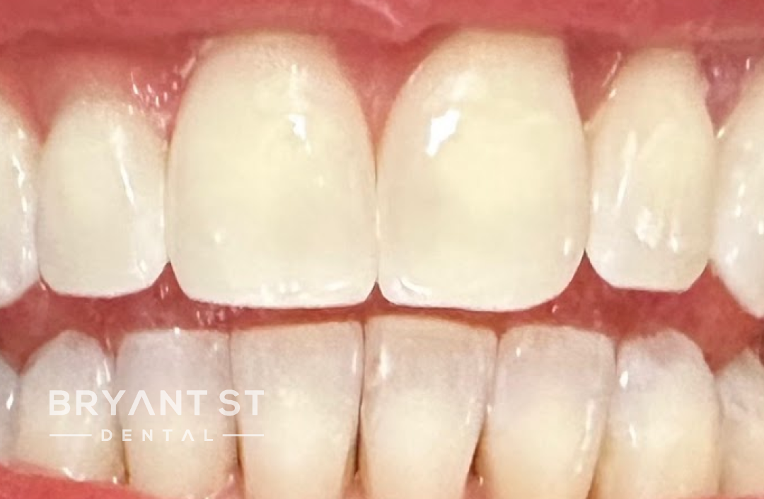 A close up of a person 's teeth with white teeth.