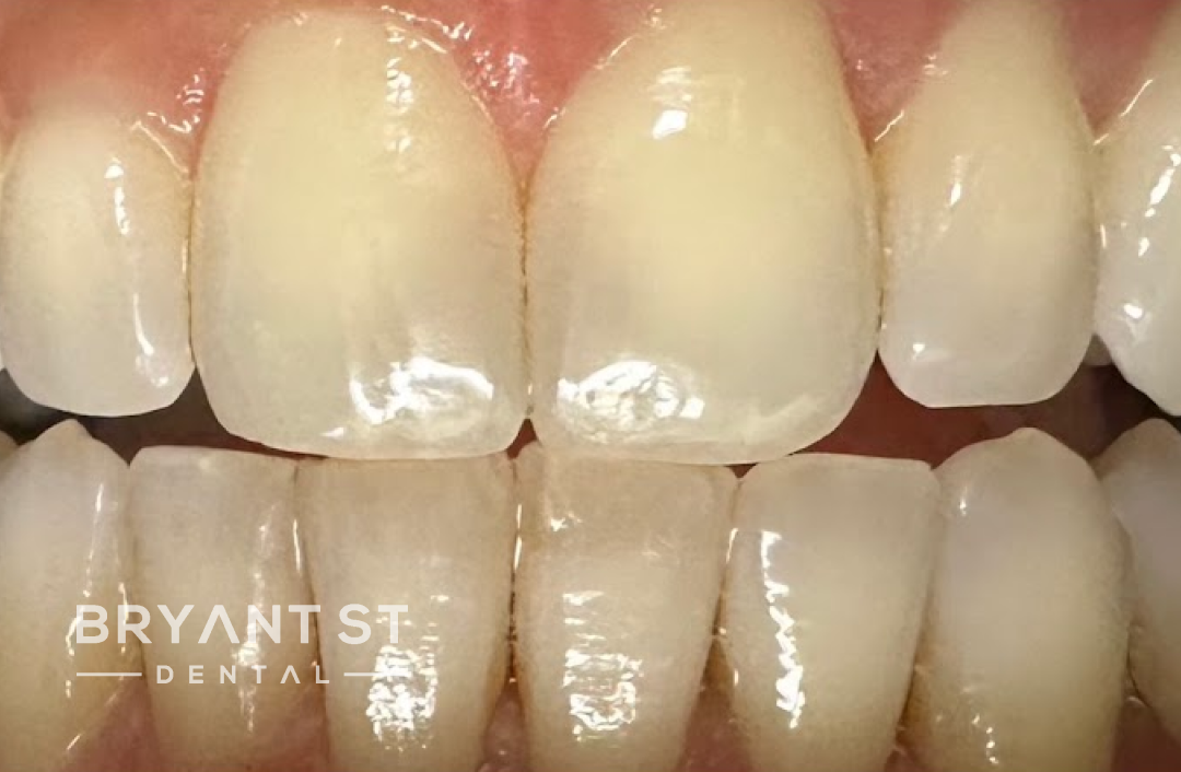 A close up of a person 's teeth with white teeth.