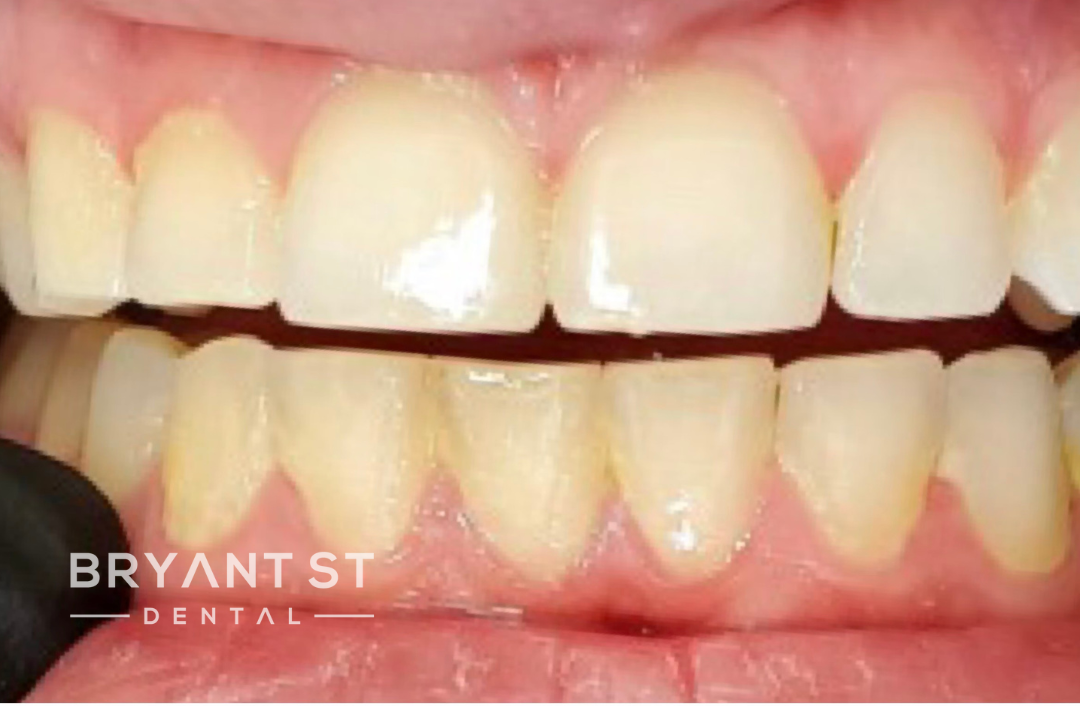 A close up of a person 's teeth with a black glove on.