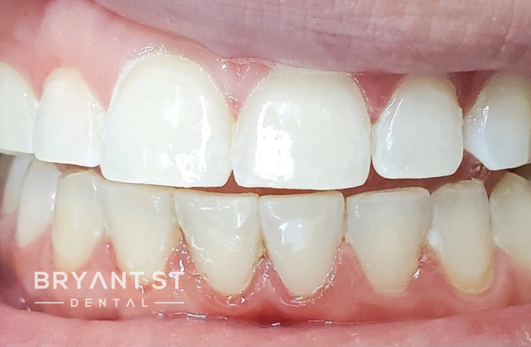 A close up of a person 's teeth with white teeth.
