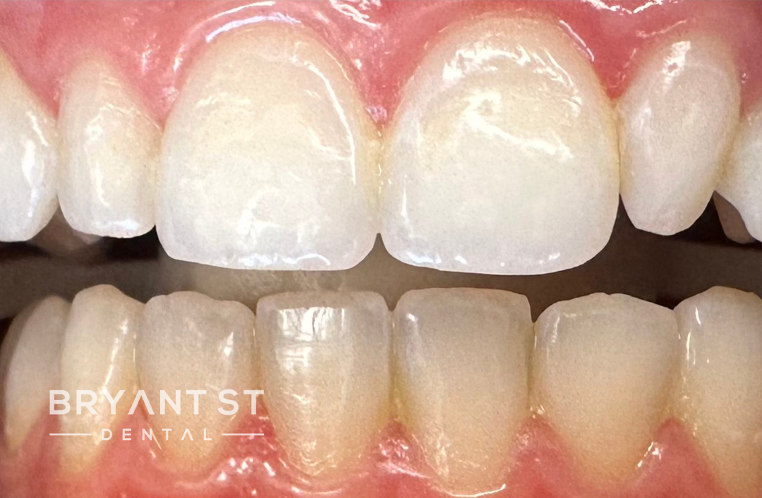 A close up of a person 's teeth with white teeth.