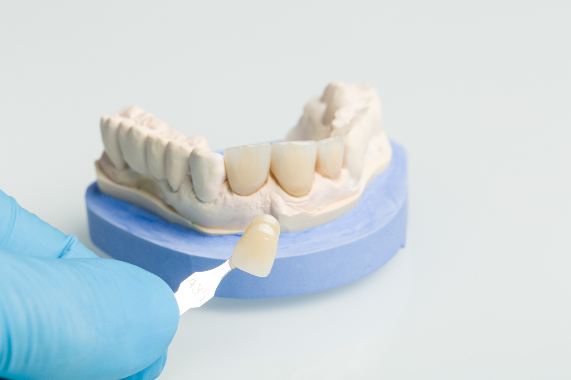 Dental Veeners