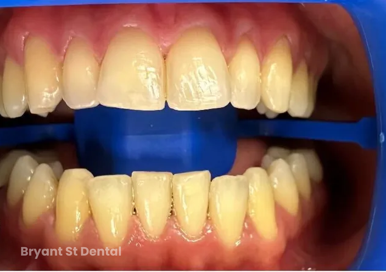 a close up of a person 's teeth with the words bryant st dental on the bottom