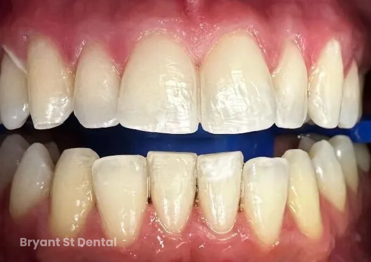 A close up of a person 's teeth with a blue toothbrush.