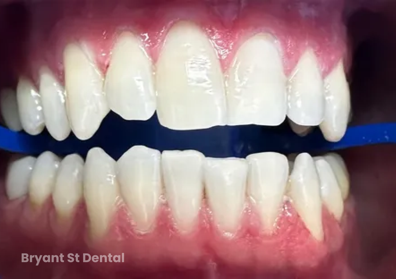 A close up of a person 's teeth with a blue toothbrush.