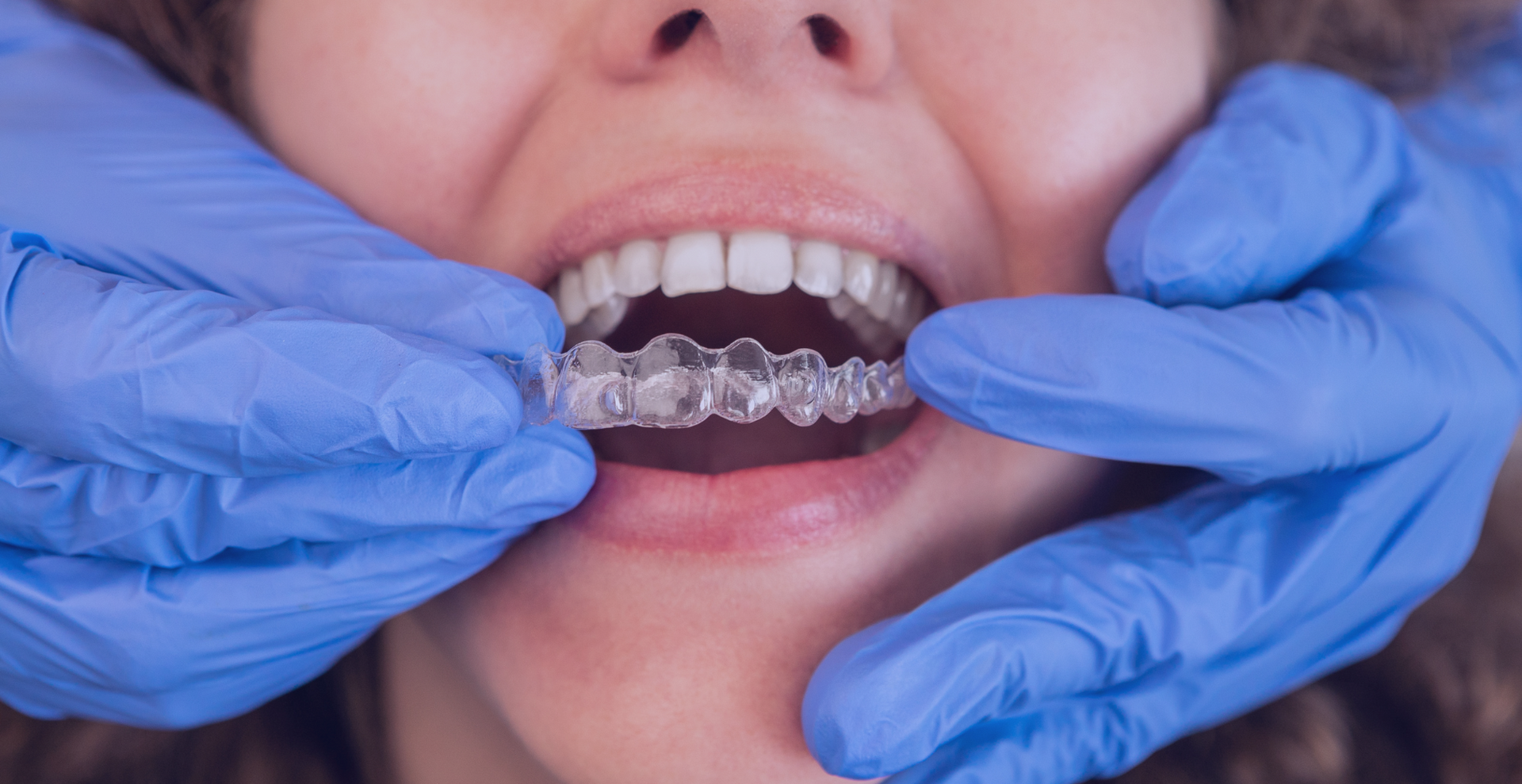 Invisalign treatment