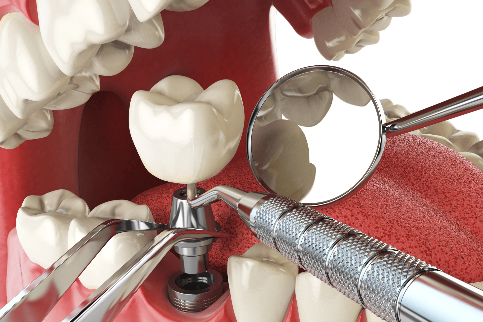 Image of sample for dental implants