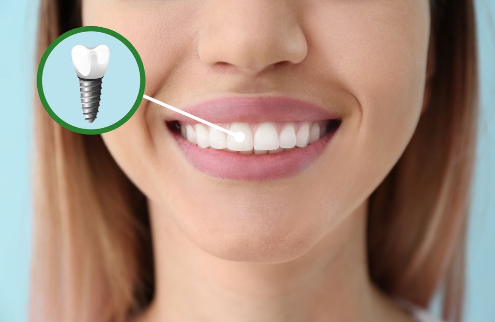 Teeth implants cost